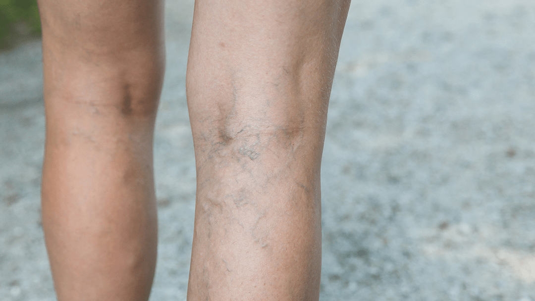 Using Compression Stockings for Deep Vein Thrombosis (Updated 2025) - TheraWear