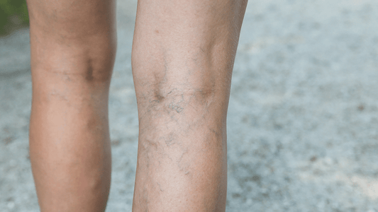 Using Compression Stockings for Deep Vein Thrombosis (Updated 2025) - TheraWear